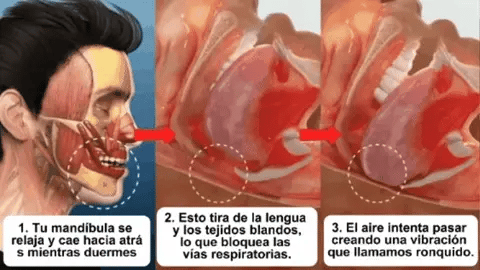 PROTECTOR BUCAL™ ANTIRRONQUIDOS / ANTIBRUXISMO / APNEA